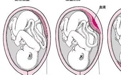 什么是前置胎盘以及它的种类